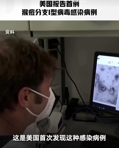 美国报告首例猴痘分支I型病毒感染病例