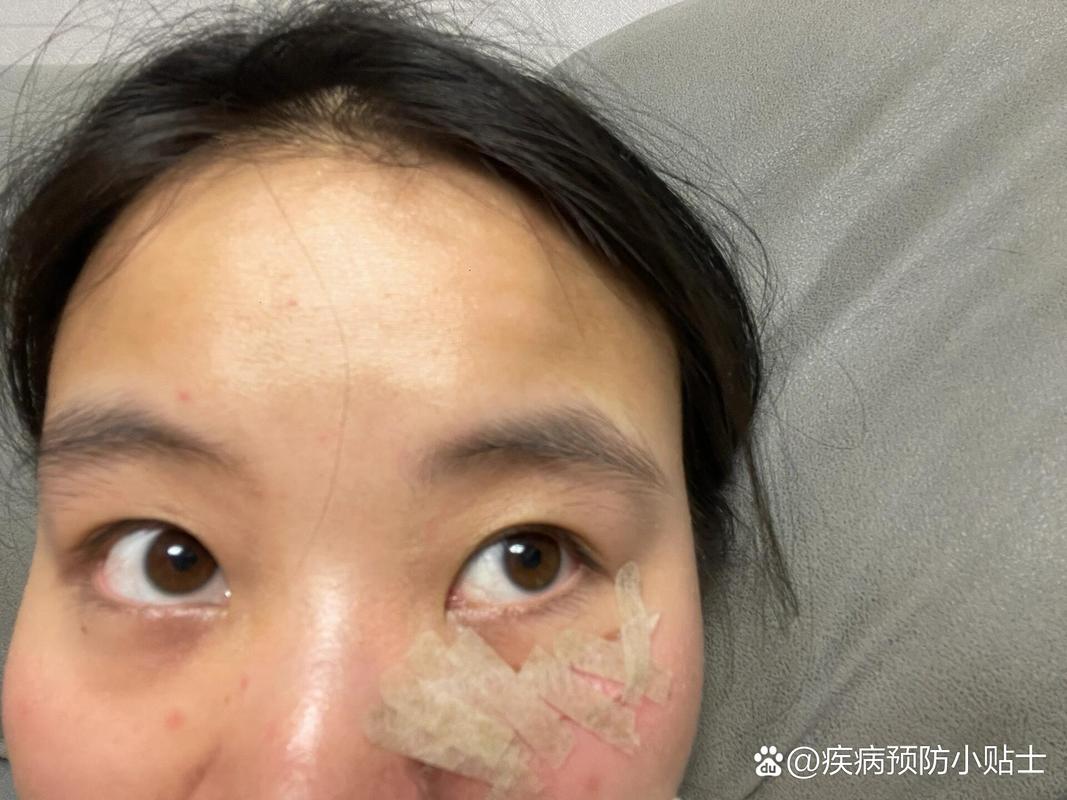 扬网健康|磕碰一下 小朋友眼眶淤青竟然是骨折了