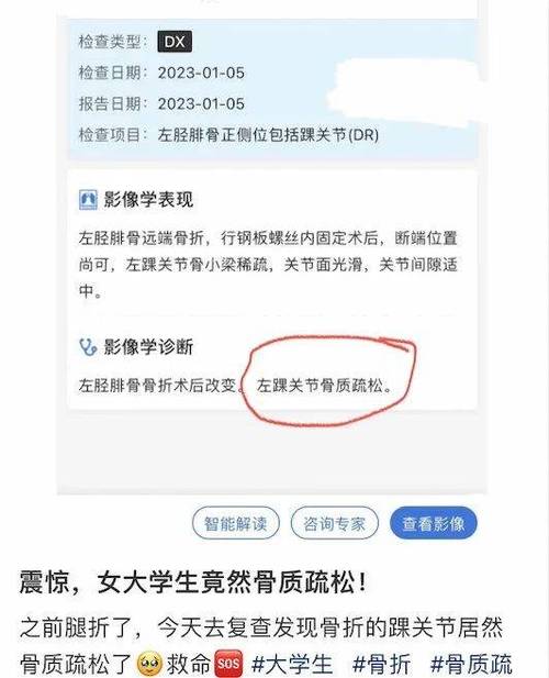 爬了一次山,杭州姑娘确诊这种病!爱喝可乐、咖啡的年轻人注意