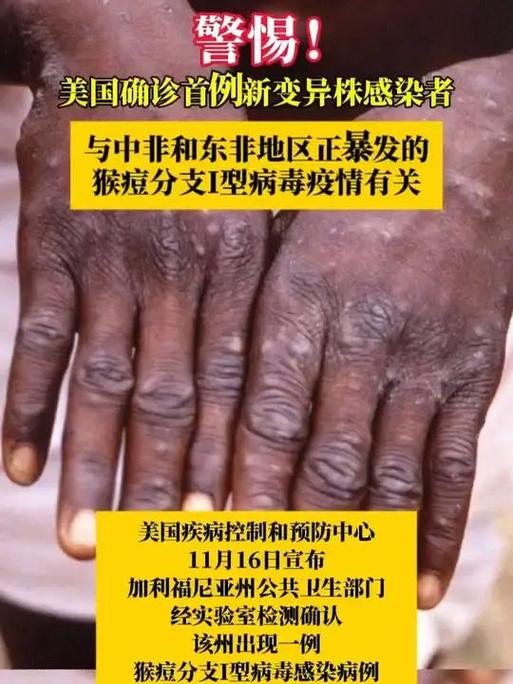 菲律宾报告今年首例猴痘病例