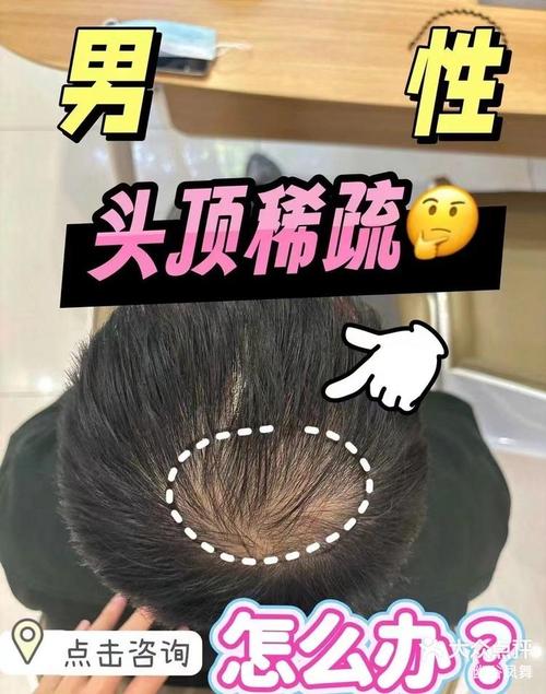 突发“头秃”可能与不良情绪有关,保护好头发少点焦虑!
