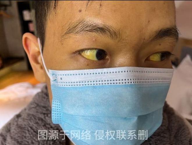 男子吃火锅后患“怪病”,眼白、皮肤都变黄了!春冬季节高发→