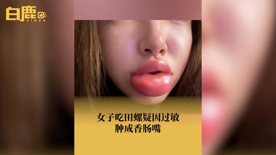 肿了两年的香肠嘴竟是坏牙在作怪