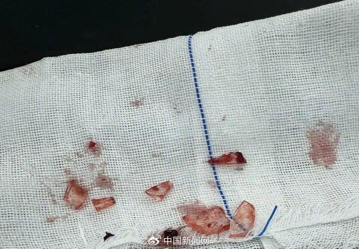 突然爆炸!男童全脸30多处伤,“脖子血往外喷”,只因这个“玩具”