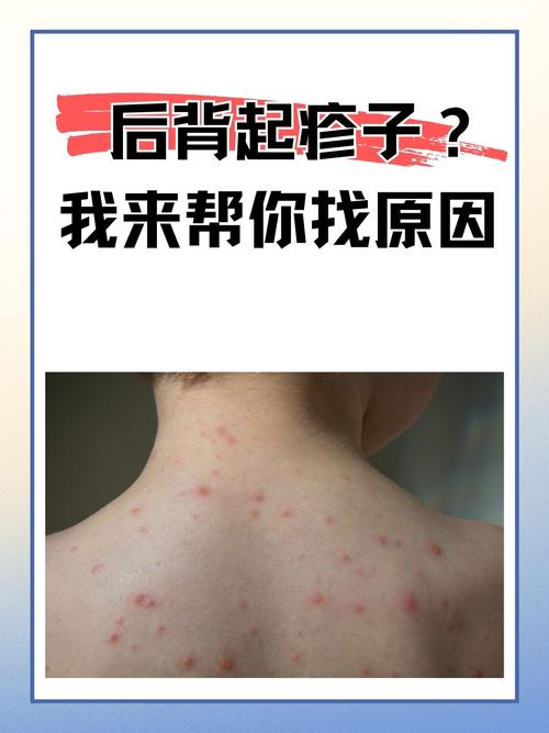 千万别抠!这类皮肤疙瘩可能是病毒感染,小心越抠越多……