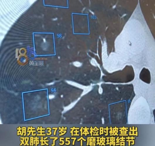37岁的他,557个肺结节!