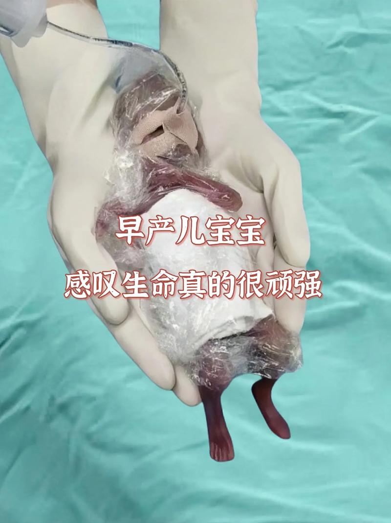 生命奇迹!360克、22周+3天的超早产儿在深圳顺利出院